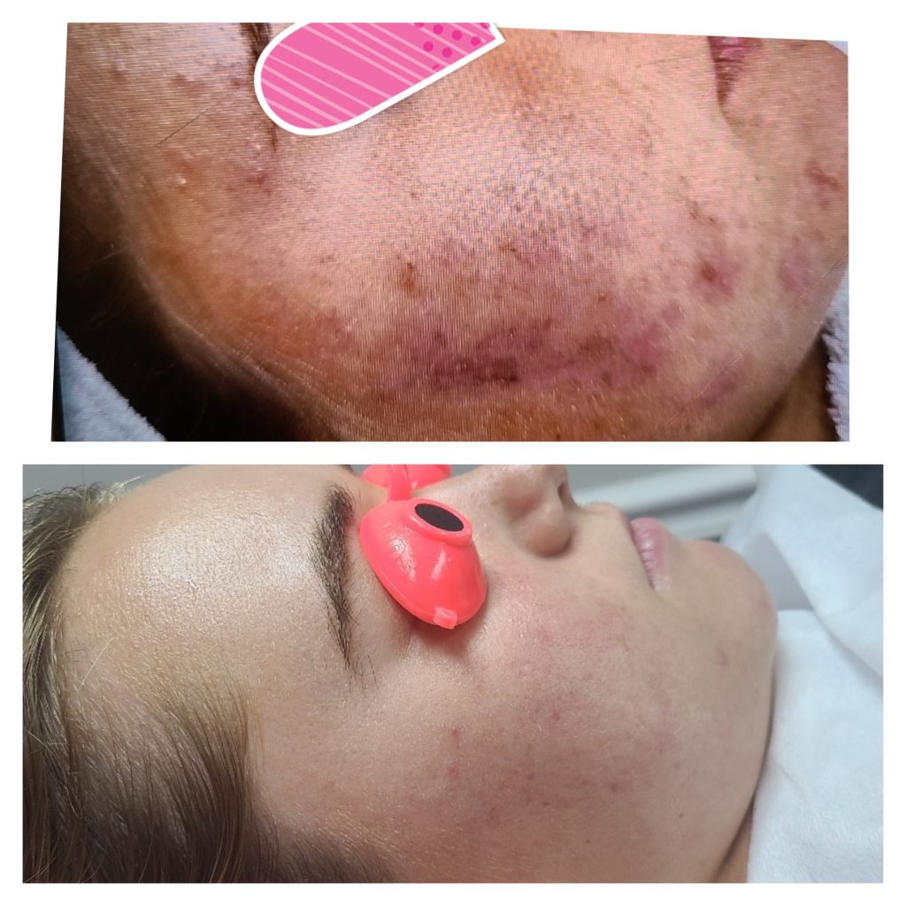 Acne client before and after a customized corrective treatment program