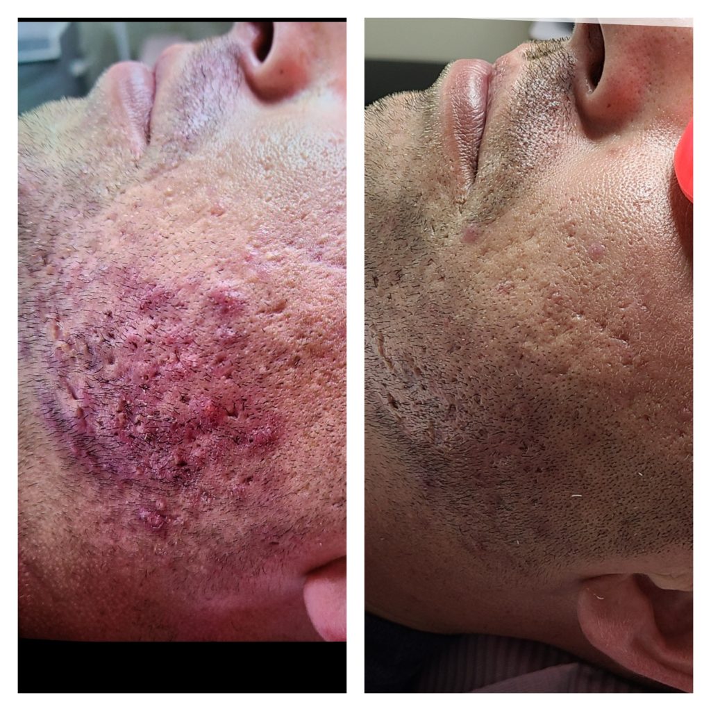 Clearer skin before and after acne treatments in Westlake, Florida