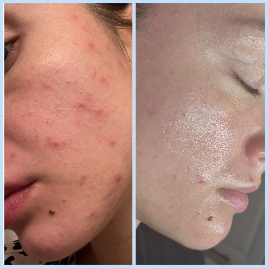 Before and after collage of acne clients treated at Palm Beach Skin Co.