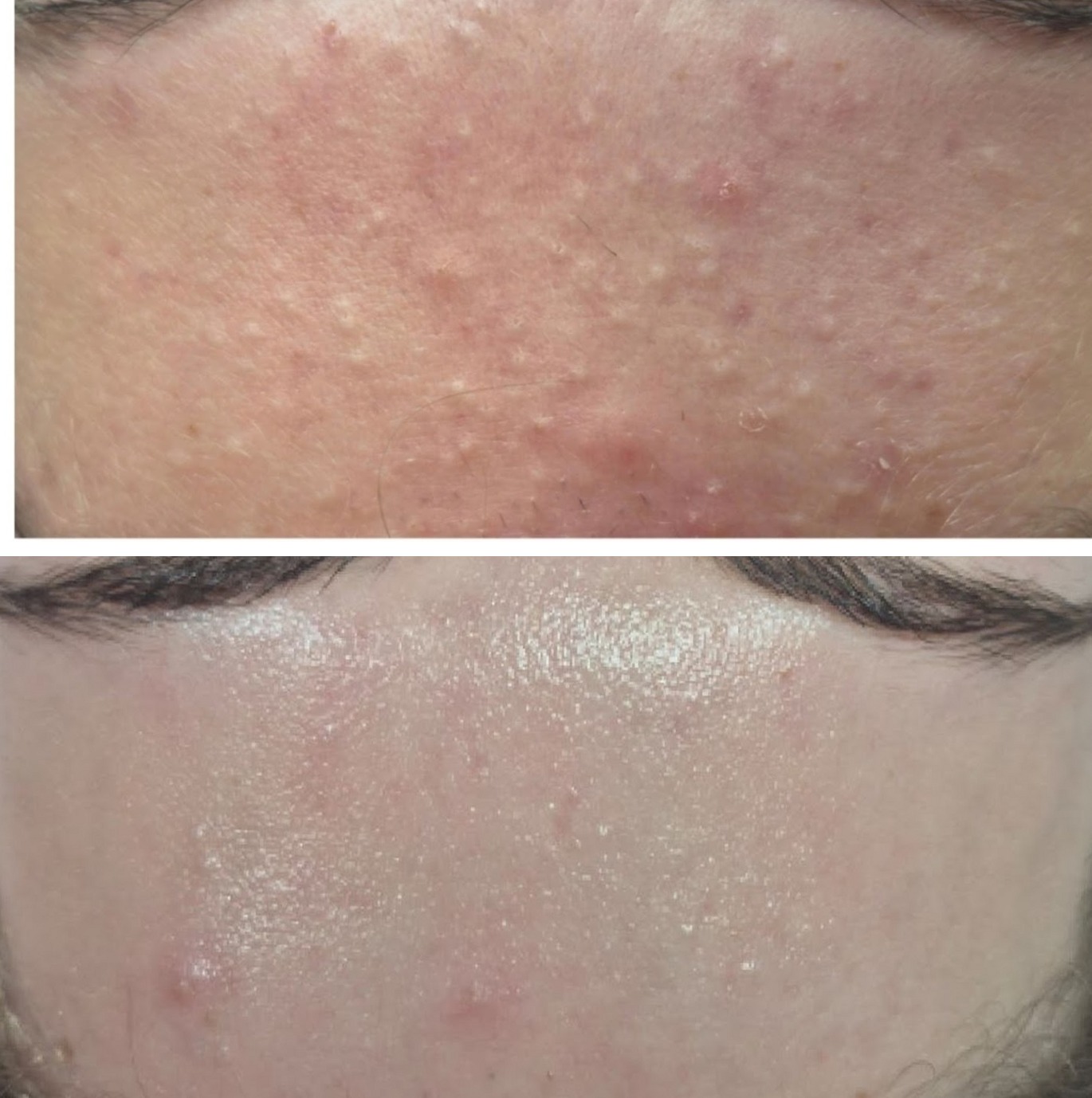 Forehead before and after: congested bumpy texture cleared to smooth, calm skin